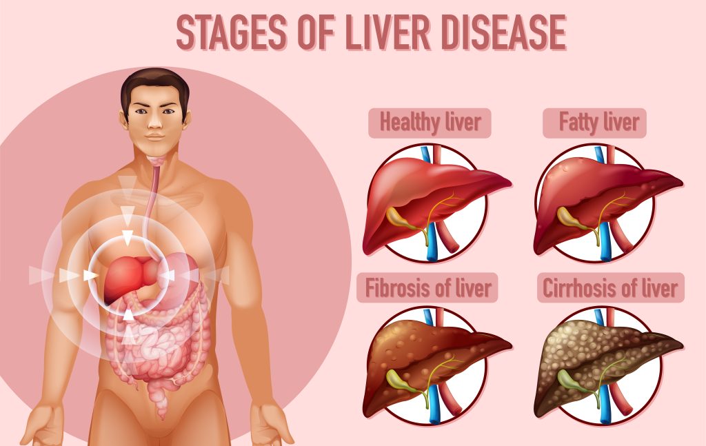 Stages of liver diseases