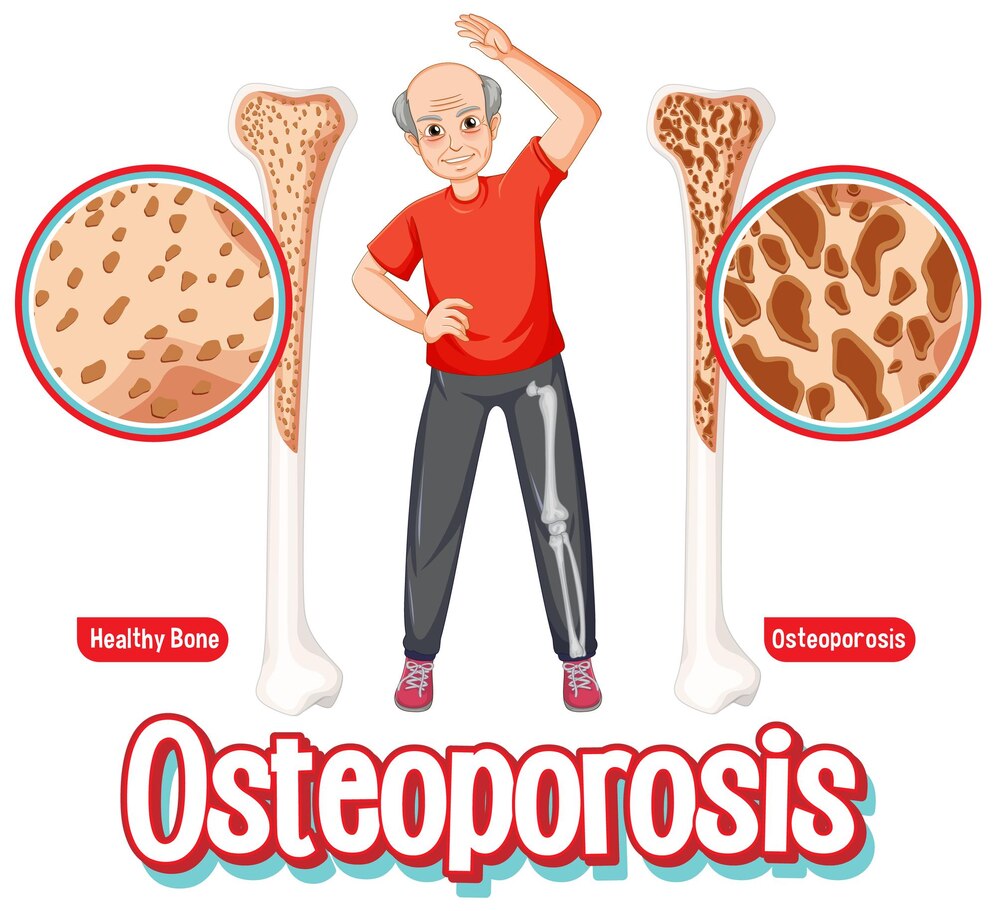 Difference between healthy bone and osteoporosis.
